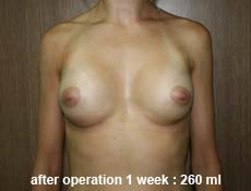 plastic-surgery-breast-augmentation 